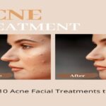 Achieve Your Best Skin: Top 10 Acne Facial Treatments to Try