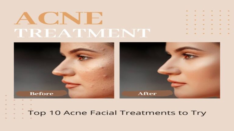 Achieve Your Best Skin: Top 10 Acne Facial Treatments to Try